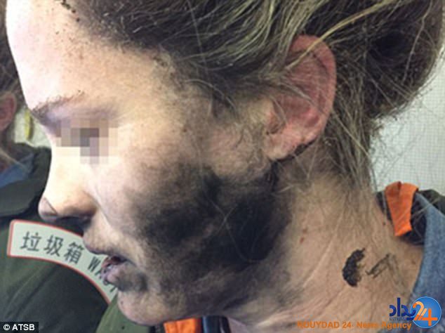 سوختگی شدید یک زن پس از انفجار هدفون در گوشش (تصاویر)