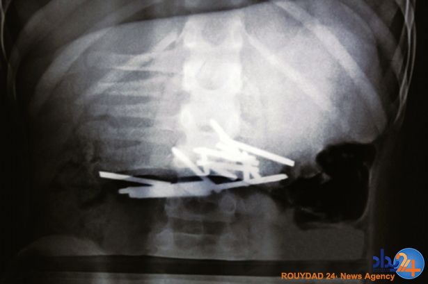 پزشکان 12 میخ را از شکم یک پسربچه بیرون آوردند (تصاویر)