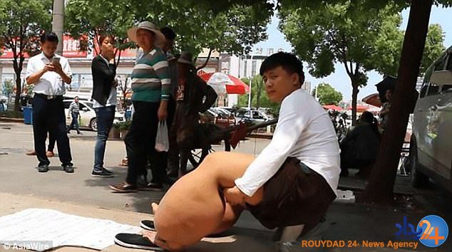 تورم 150 کیلویی پاهای پسر چینی به دلیل نیش پشه (فیلم و تصاویر)