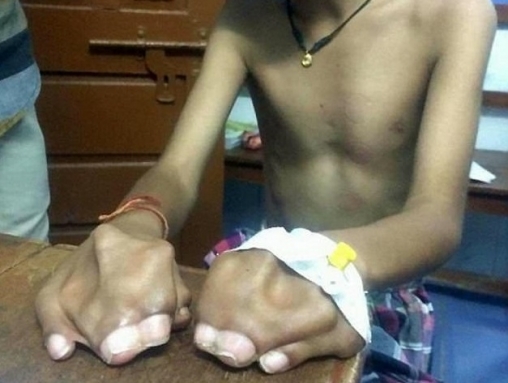 انگشتان عجیب پسر هندی (تصاویر)