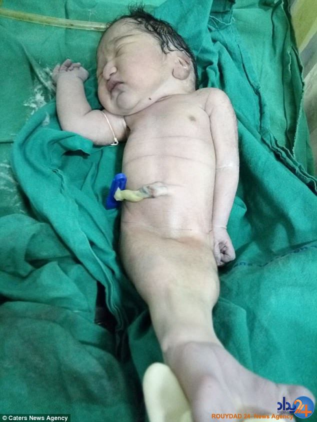 نوزادی که با سندروم پری دریایی به دنیا آمد (فیلم و تصاویر)