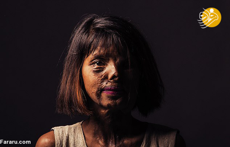 زندگی دختر جوان، ۲۳ سال پس از اسیدپاشی +تصاویر