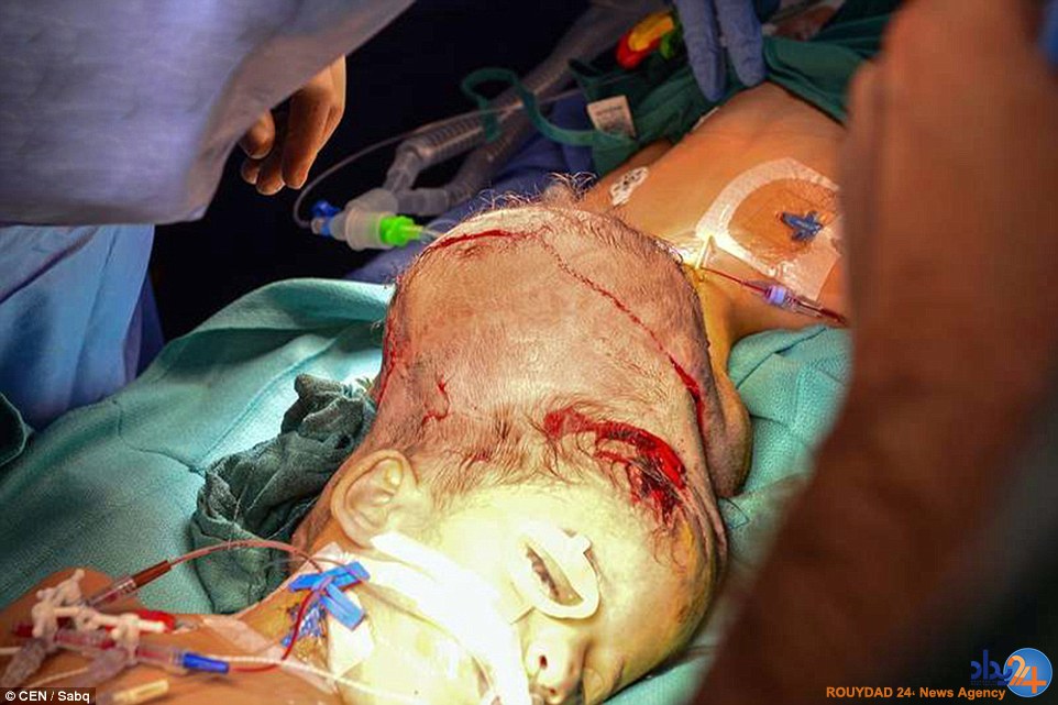 دوقلوهای سوری پس از چهار سال از هم جدا شدند (تصاویر) دوقلوهای سوری پس از چهار سال از هم جدا شدند (تصاویر)