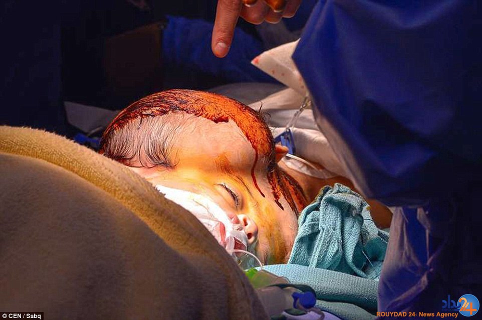 دوقلوهای سوری پس از چهار سال از هم جدا شدند (تصاویر) دوقلوهای سوری پس از چهار سال از هم جدا شدند (تصاویر)