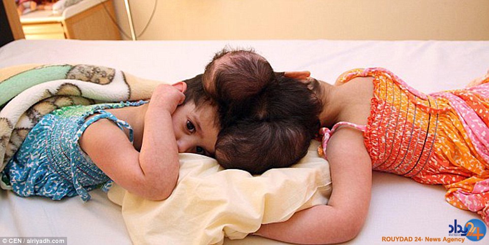 دوقلوهای سوری پس از چهار سال از هم جدا شدند (تصاویر) دوقلوهای سوری پس از چهار سال از هم جدا شدند (تصاویر)