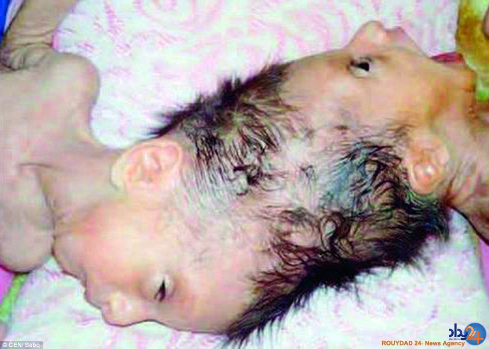 دوقلوهای سوری پس از چهار سال از هم جدا شدند (تصاویر) دوقلوهای سوری پس از چهار سال از هم جدا شدند (تصاویر)