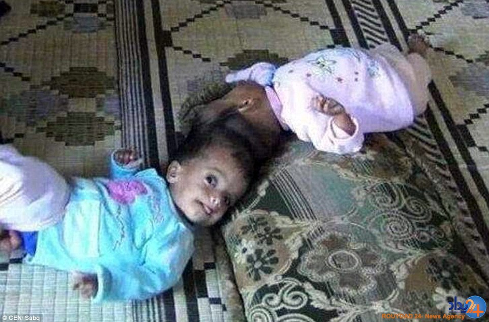 دوقلوهای سوری پس از چهار سال از هم جدا شدند (تصاویر) دوقلوهای سوری پس از چهار سال از هم جدا شدند (تصاویر)