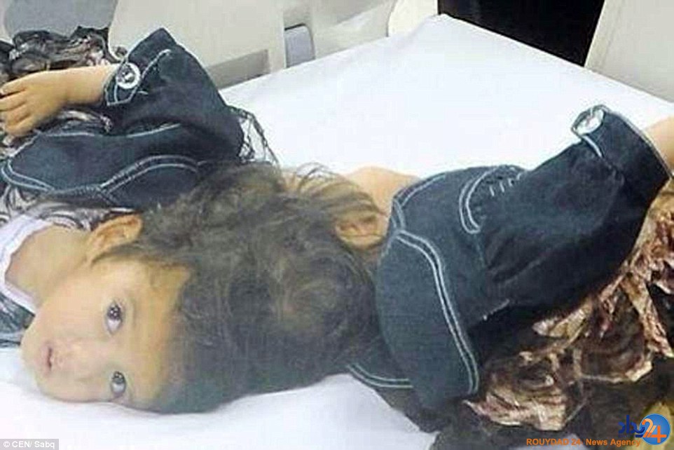 دوقلوهای سوری پس از چهار سال از هم جدا شدند (تصاویر) دوقلوهای سوری پس از چهار سال از هم جدا شدند (تصاویر)