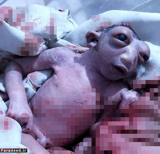 تولد دختری عجیب در هند! (تصاویر) تولد دختری عجیب در هند! (تصاویر)