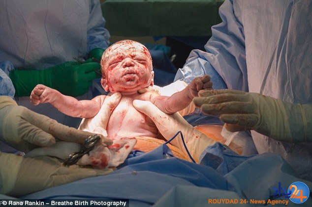 مادر استرالیایی خود را سزارین کرد