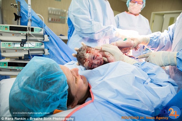 مادر استرالیایی خود را سزارین کرد