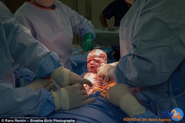 مادر استرالیایی خود را سزارین کرد