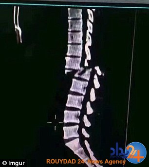 شکستن ستون فقرات وزنه‌برداری که اشتباه وزنه زد (فیلم و تصاویر)