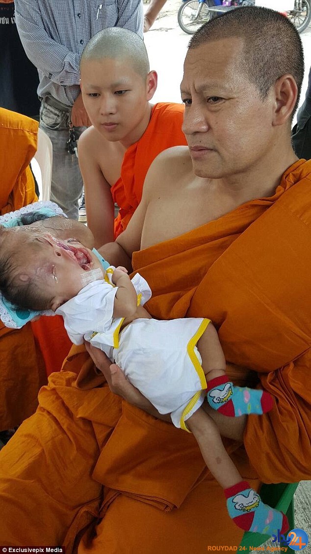 دختری که نابینا و بدون جمجمه به دنیا آمد (تصاویر)