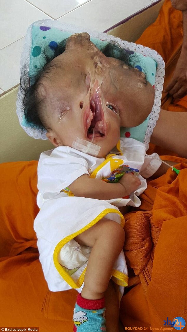 دختری که نابینا و بدون جمجمه به دنیا آمد (تصاویر)