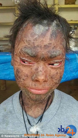 این دختر هندی هر شش هفته مانند مار پوست می‌اندازد (تصاویر)