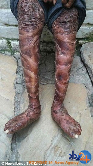 این دختر هندی هر شش هفته مانند مار پوست می‌اندازد (تصاویر)