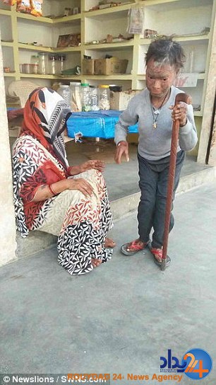 این دختر هندی هر شش هفته مانند مار پوست می‌اندازد (تصاویر)