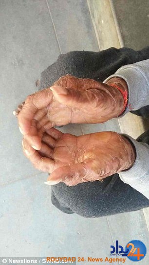 این دختر هندی هر شش هفته مانند مار پوست می‌اندازد (تصاویر)