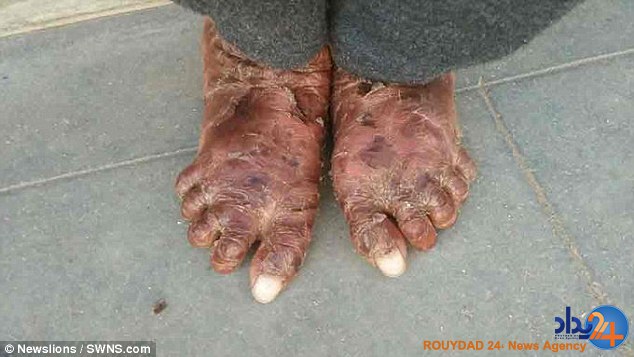 این دختر هندی هر شش هفته مانند مار پوست می‌اندازد (تصاویر)