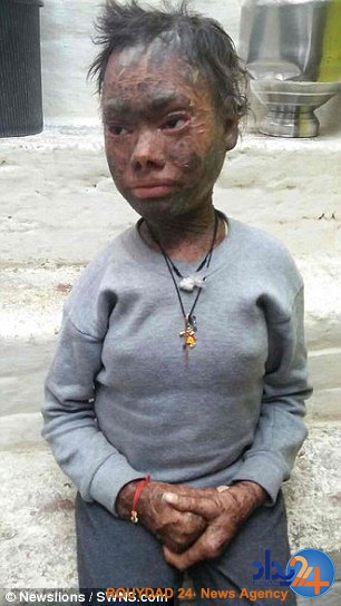 این دختر هندی هر شش هفته مانند مار پوست می‌اندازد (تصاویر)