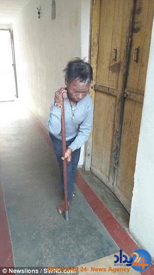 این دختر هندی هر شش هفته مانند مار پوست می‌اندازد (تصاویر)