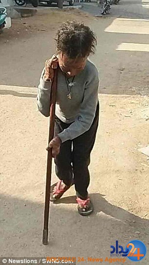 این دختر هندی هر شش هفته مانند مار پوست می‌اندازد (تصاویر)