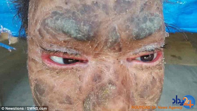 این دختر هندی هر شش هفته مانند مار پوست می‌اندازد (تصاویر)