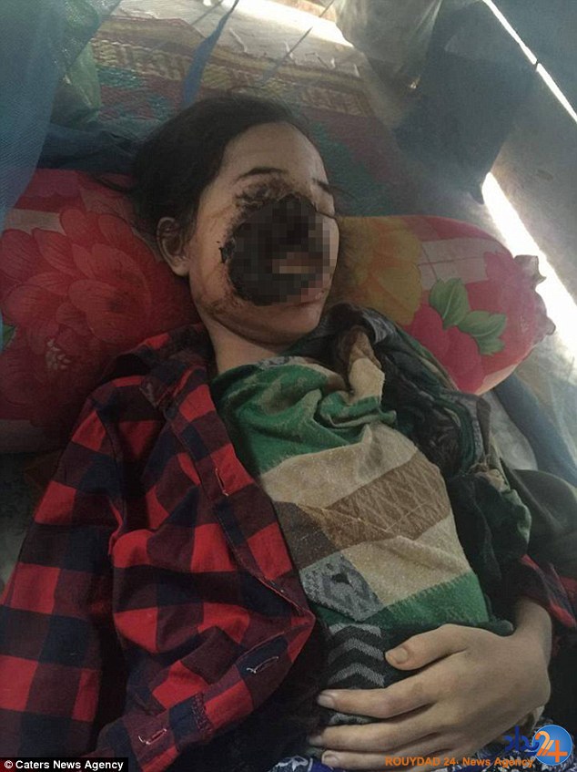 باکتری گوشت‌خوار صورت نوجوان کامبوجی را خورد (تصاویر)