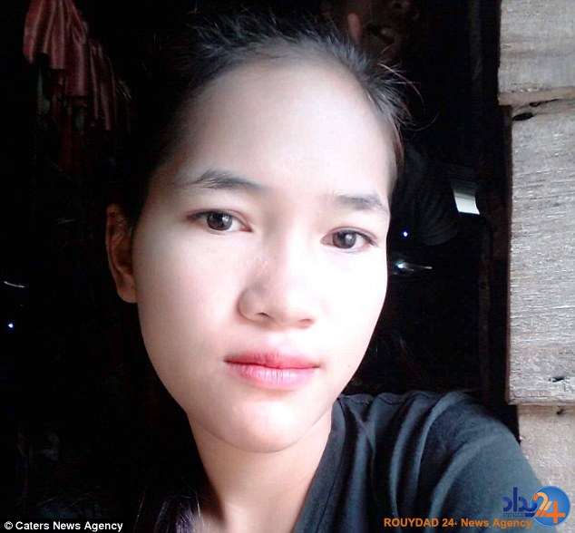 باکتری گوشت‌خوار صورت نوجوان کامبوجی را خورد (تصاویر)