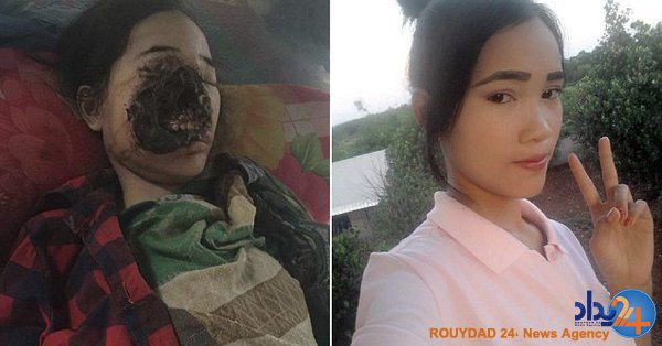 باکتری گوشت‌خوار صورت نوجوان کامبوجی را خورد (تصاویر)