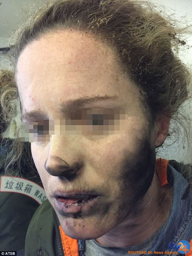 سوختگی شدید یک زن پس از انفجار هدفون در گوشش (تصاویر)