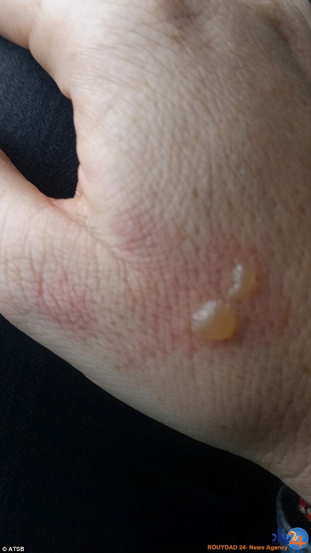 سوختگی شدید یک زن پس از انفجار هدفون در گوشش (تصاویر) سوختگی شدید یک زن پس از انفجار هدفون در گوشش (تصاویر)