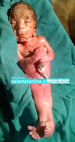 تولد یک «پری دریایی» انسانی در هند (تصویر)