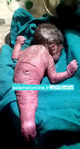 تولد یک «پری دریایی» انسانی در هند (تصویر)