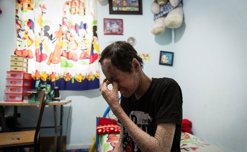 پولک ماهی بر تن رنجور جواد (تصاویر)