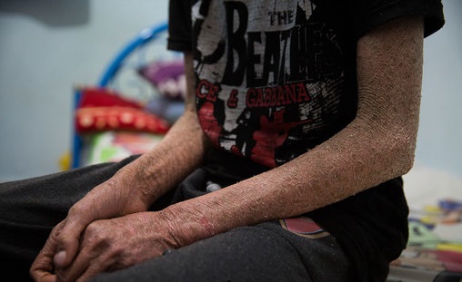 پولک ماهی بر تن رنجور جواد (تصاویر)