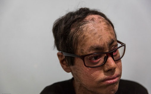 پولک ماهی بر تن رنجور جواد (تصاویر)