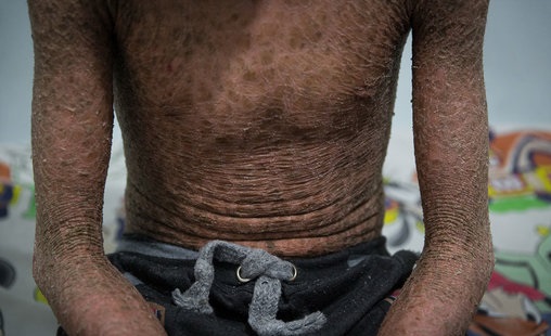 پولک ماهی بر تن رنجور جواد (تصاویر)