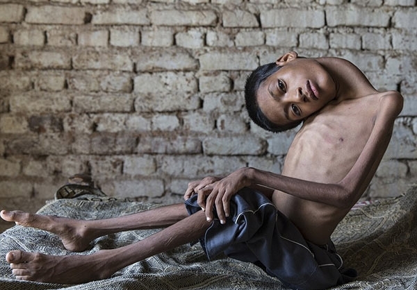 جراحی پسرک هندی با ۱۸۰ درجه وارونگی گردن (تصویر) جراحی پسرک هندی با ۱۸۰ درجه وارونگی گردن (تصویر)