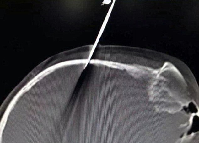 پدر بی‌رحم قیچی را در سر دختر 10 ساله‌اش فرو کرد (تصاویر)