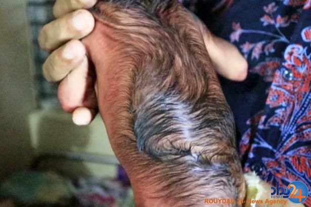 نوازدی که با چهره‌ای 80 ساله به دنیا آمد (تصاویر)