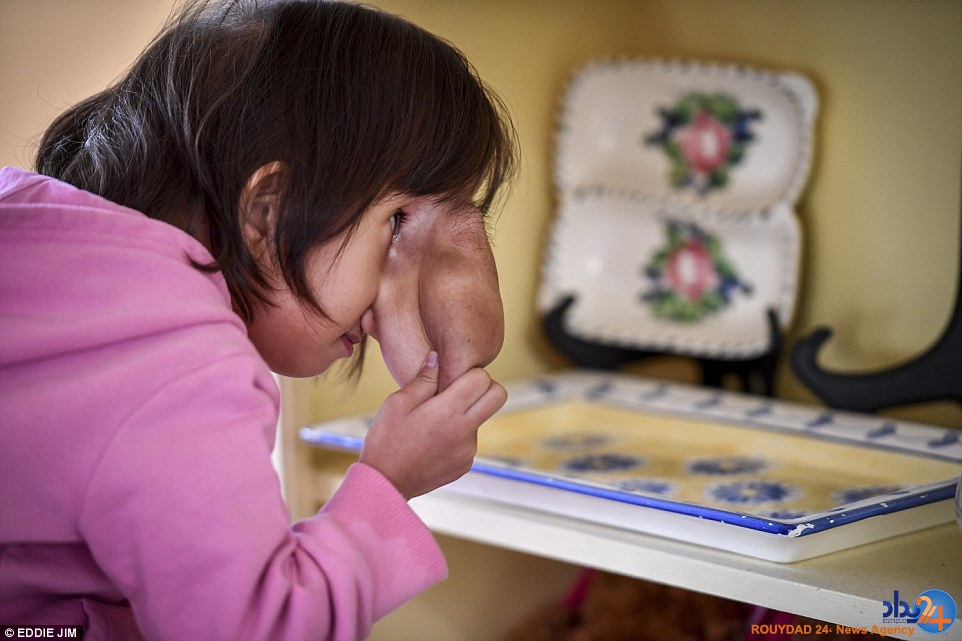 عارضه نادر روی صورت دختر چهارساله (تصاویر)