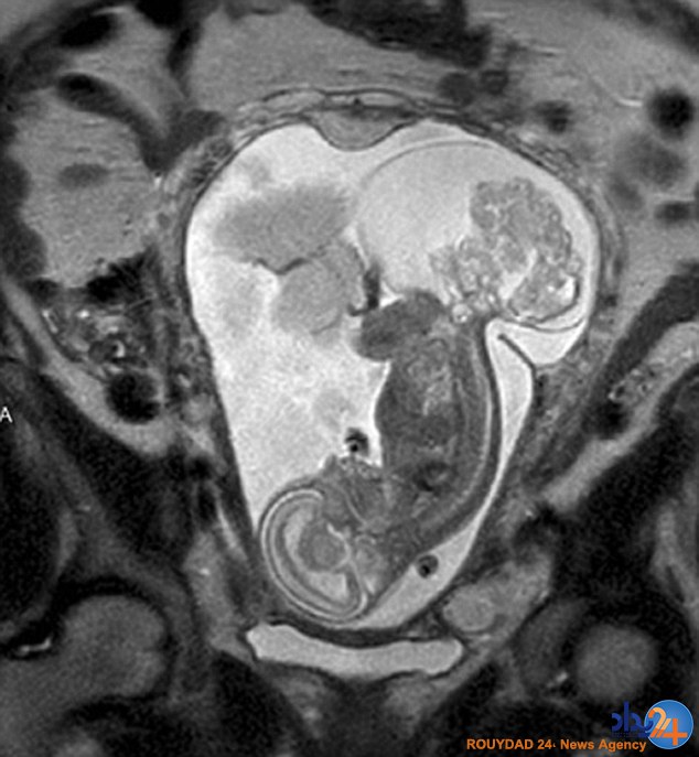 نوزادی که دو بار به دنیا آمد (تصاویر)