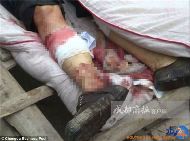 مرگ زنی که پاهایش توسط شوهر اره شد(تصاویر) مرگ زنی که پاهایش توسط شوهر اره شد(تصاویر)