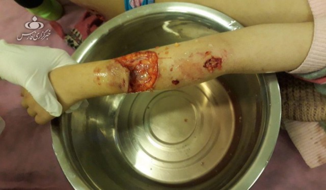 جزییات حادثه وحشتناک حمله دو سگ به دختر بچه