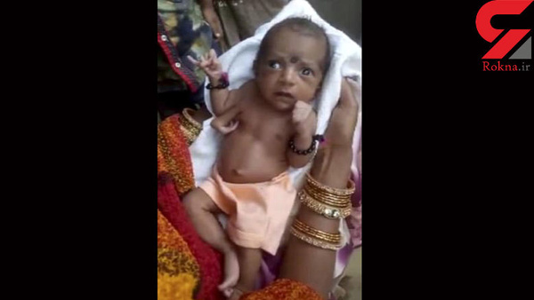 تولد نوزاد دختر با سه دست+تصویر