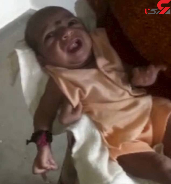 تولد نوزاد دختر با سه دست+تصویر