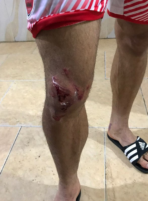 عکس زانوی زخمی ترابی در اینستاگرام فیلتر شد