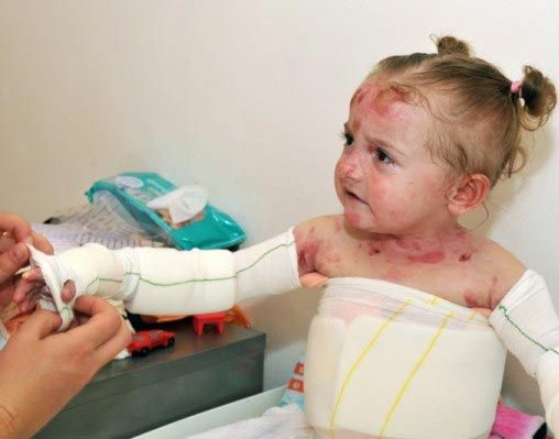 بارقه‌های امید برای درمان بیماران پروانه‌ای با سلول‌های بنیادی